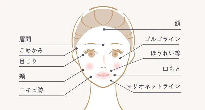 PRP皮膚再生療法が適応となる箇所の図解イラスト