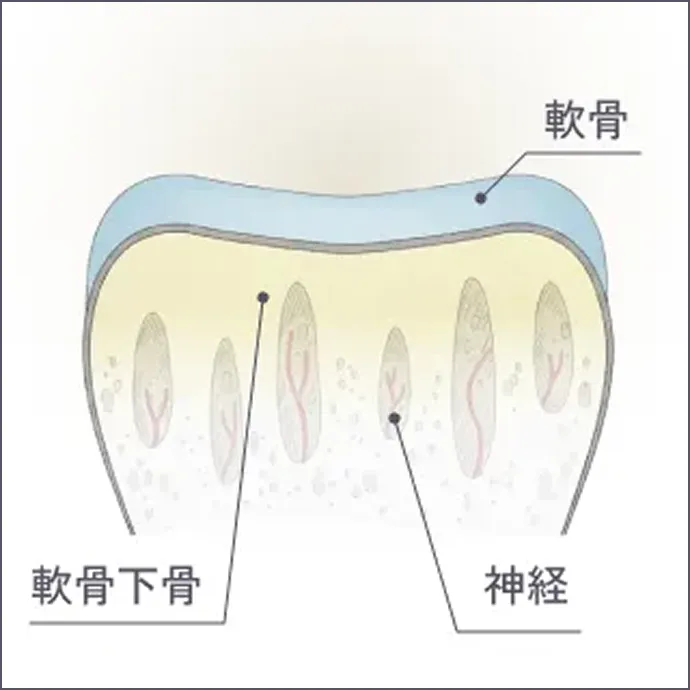 変形性関節症の進行 正常から軽症の解説イラスト