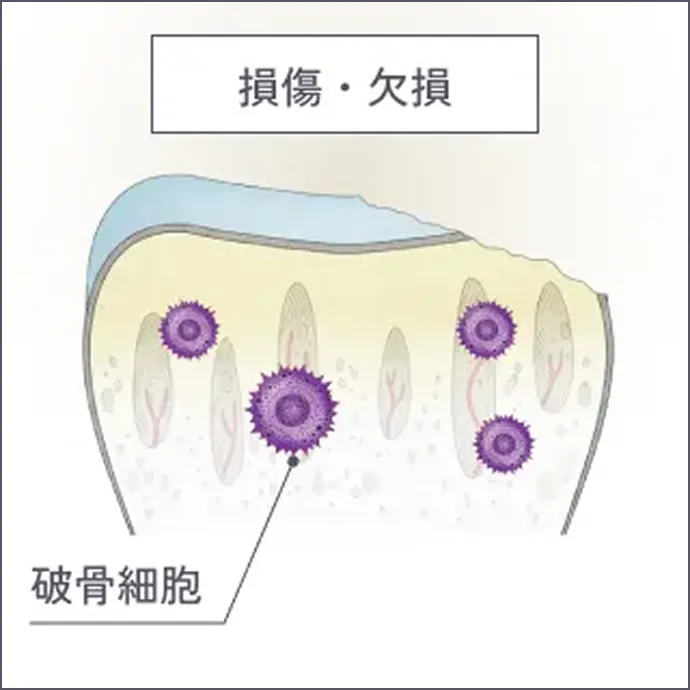 変形性関節症の進行 中等症の解説イラスト