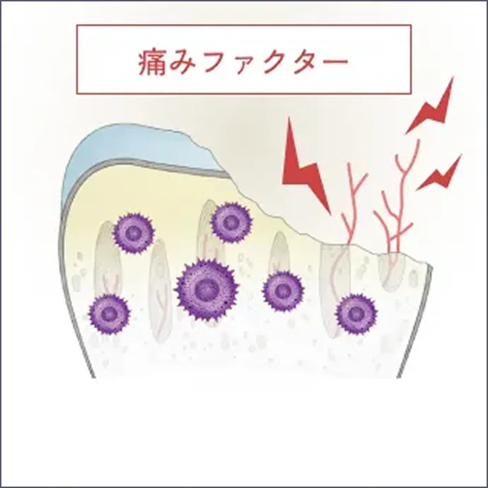 変形性関節症の進行 重症の解説イラスト