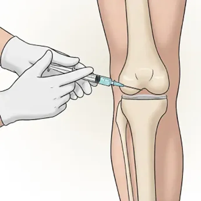 治療の3ステップ目 高濃度の血漿成分を患部へ注射します