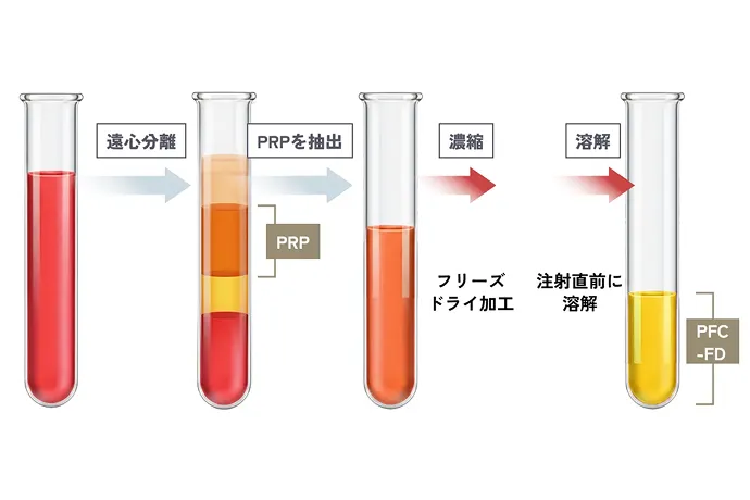PFC−FD療法のイメージ画像