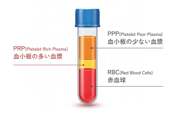 PRP（多血小板血漿）のイメージ図