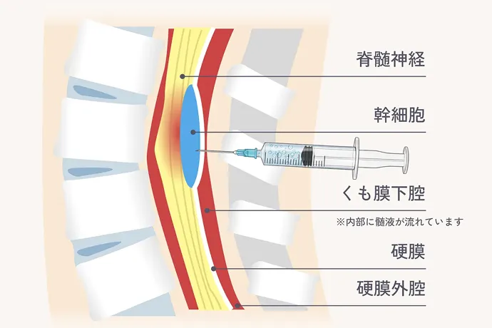脊髄腔内ダイレクト注射療法のイメージ図