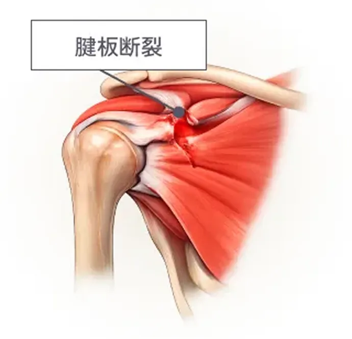 腱板断裂のイラスト図