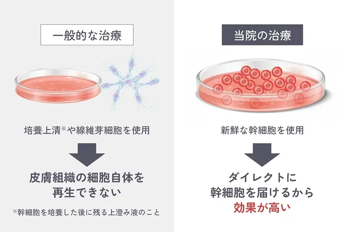 一般的な治療 培養上清※や線維芽細胞を使用 皮膚組織の細胞自体を再生できない ※幹細胞を培養した後に残る上澄み液のこと 当院の治療 新鮮な幹細胞を使用 ダイレクトに幹細胞に届けるから効果が高い