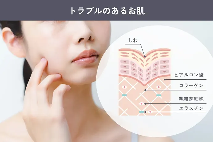 トラブルのあるお肌の図解と肌を気にする女性の様子