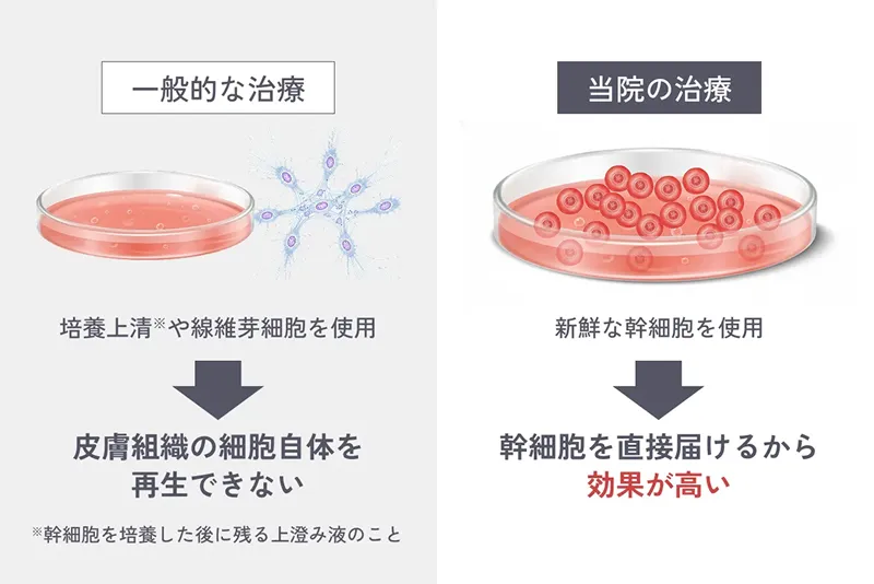一般的な治療 培養上清※や線維芽細胞を使用 皮膚組織の細胞自体を再生できない ※幹細胞を培養した後に残る上澄み液のこと 当院の治療 新鮮な幹細胞を使用 ダイレクトに幹細胞を届けるから効果が高い