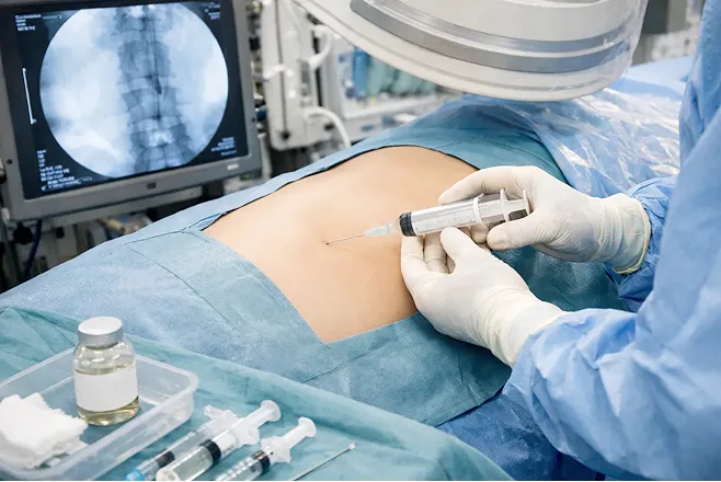 ステップ2 脊髄くも膜下腔投与