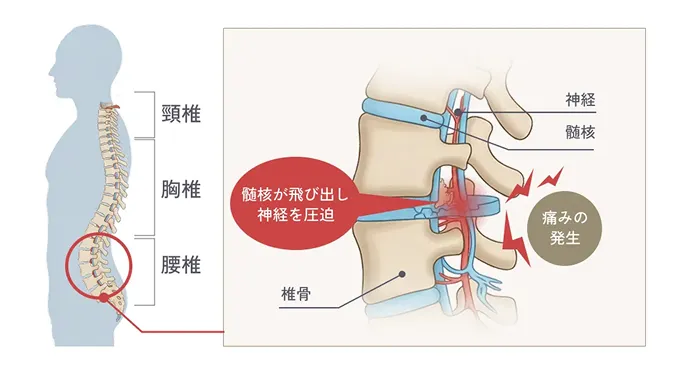 椎間板ヘルニアの解説イラスト